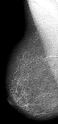 Mediolateral oblique projection of breast