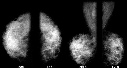 Breast Mammogram exam