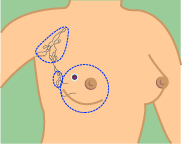 Radical Mastectomy