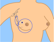 Simple Mastectomy