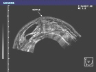 Patient with multiple cysts and other masses that indicate breast disease.