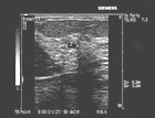 This image shows a small cyst within the glandular breast tissue.