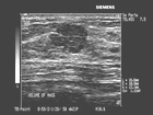 Circumscribed, slightly lobulated fibroadenoma