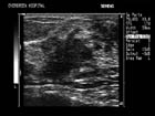 Ductal invasion associated with this malignant breast mass