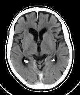 CT scan of brain