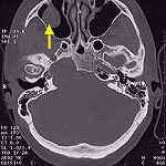 CT of the sinuses and inner ear canal