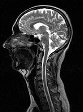 MRI of the head and cervical spine (neck)