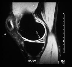 MRI of knee