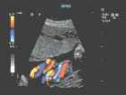 Ultrasound image of blood vessels of umbilical cord