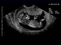 Ultrasound of baby