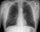 Chest x-ray